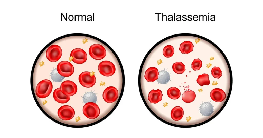 Thalassemia Major vs. Thalassemia Minor: Understanding The Differences ...